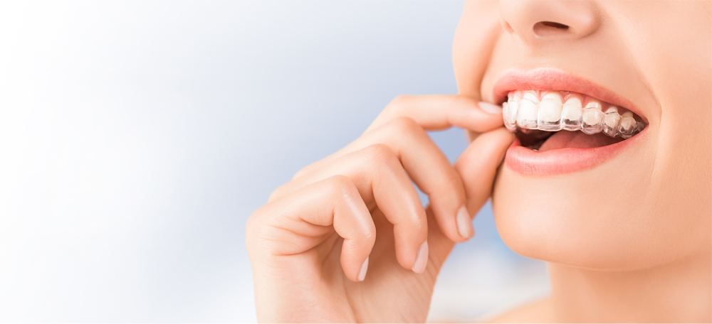 Benefits Of Invisalign