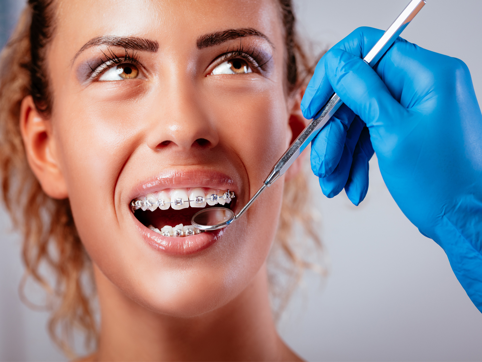 How You Can Clean Your Braces Effectively?