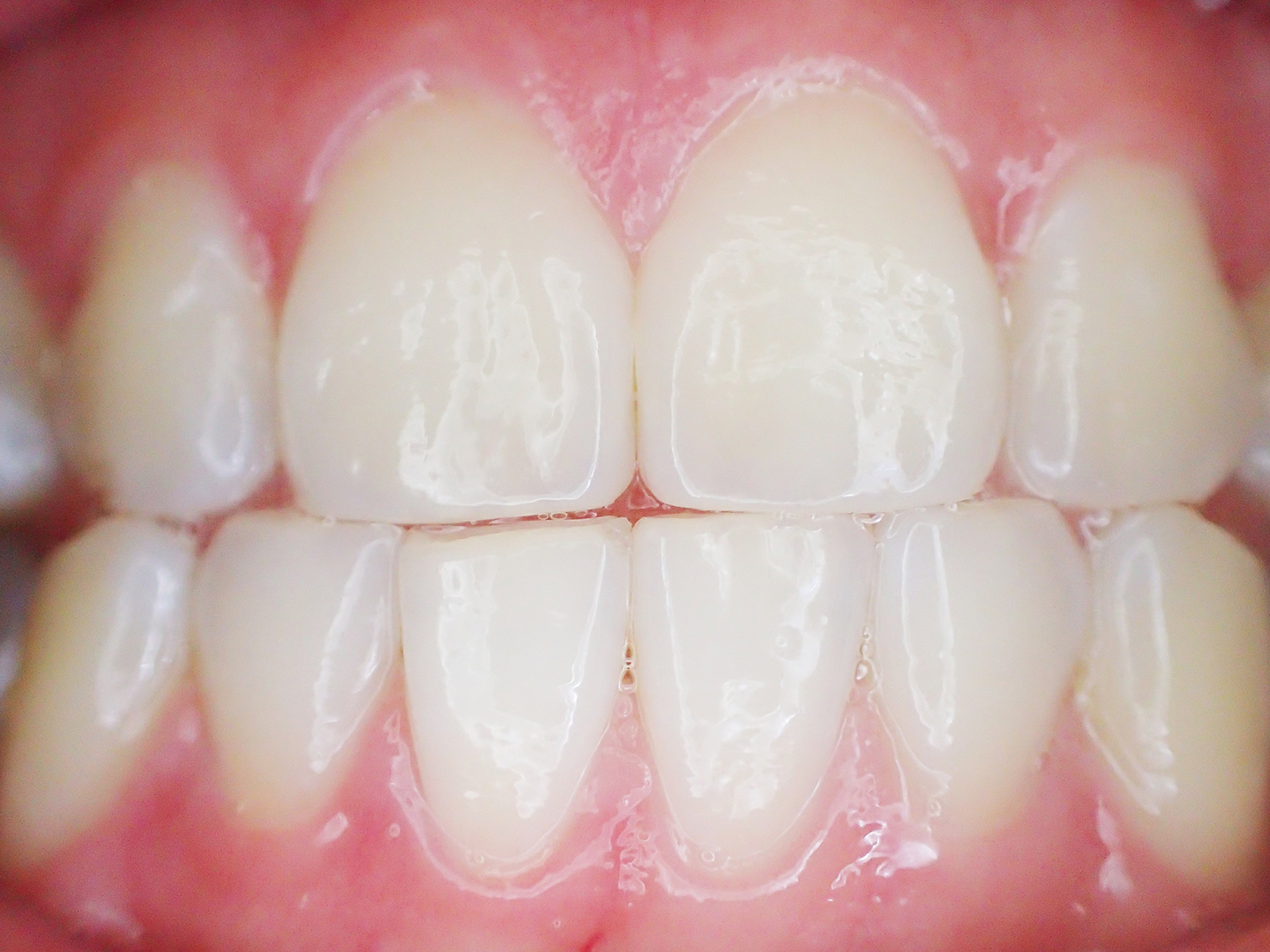 What Are Craze Lines On Teeth?