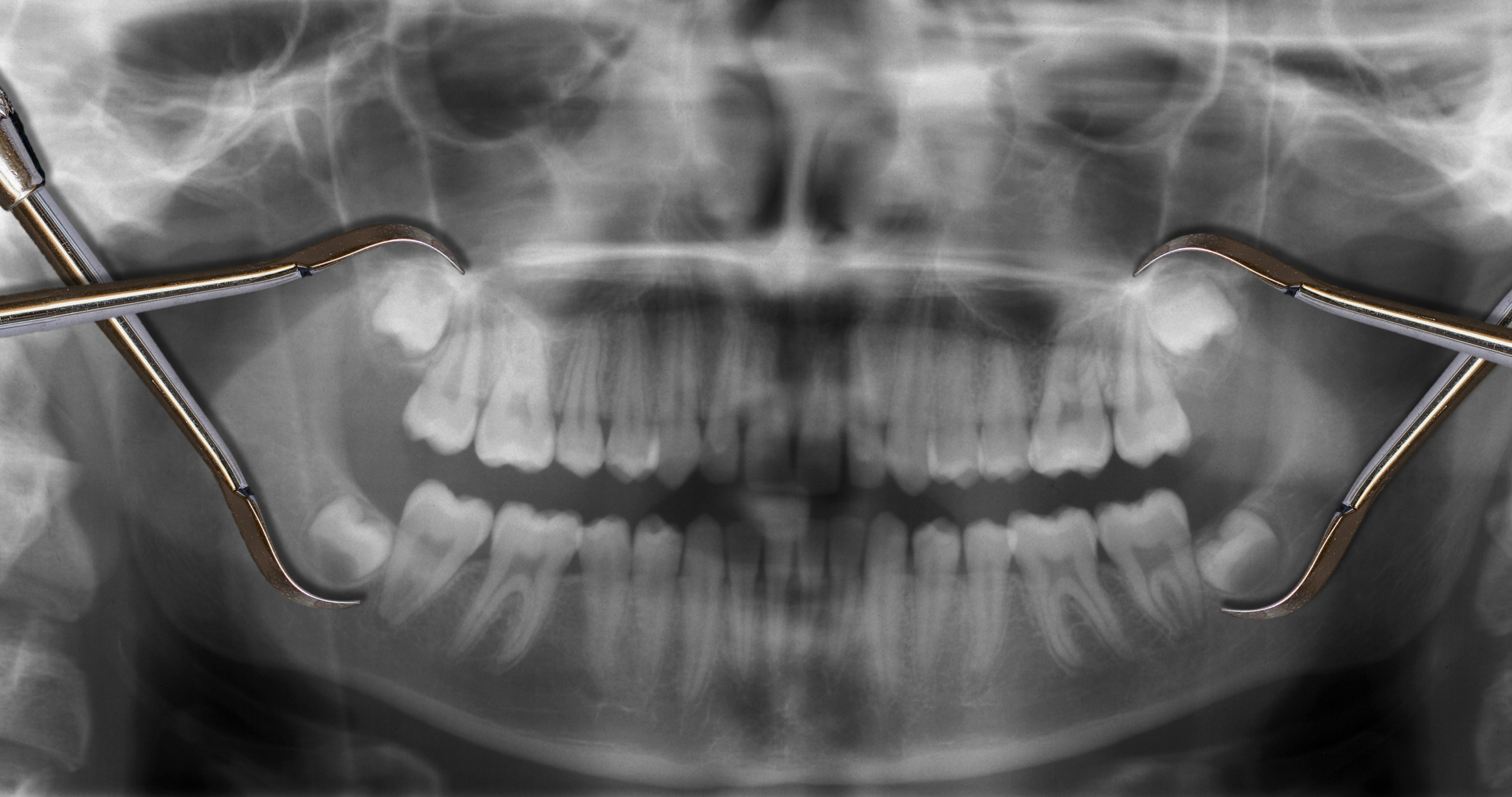 Are dental x-rays safe for children