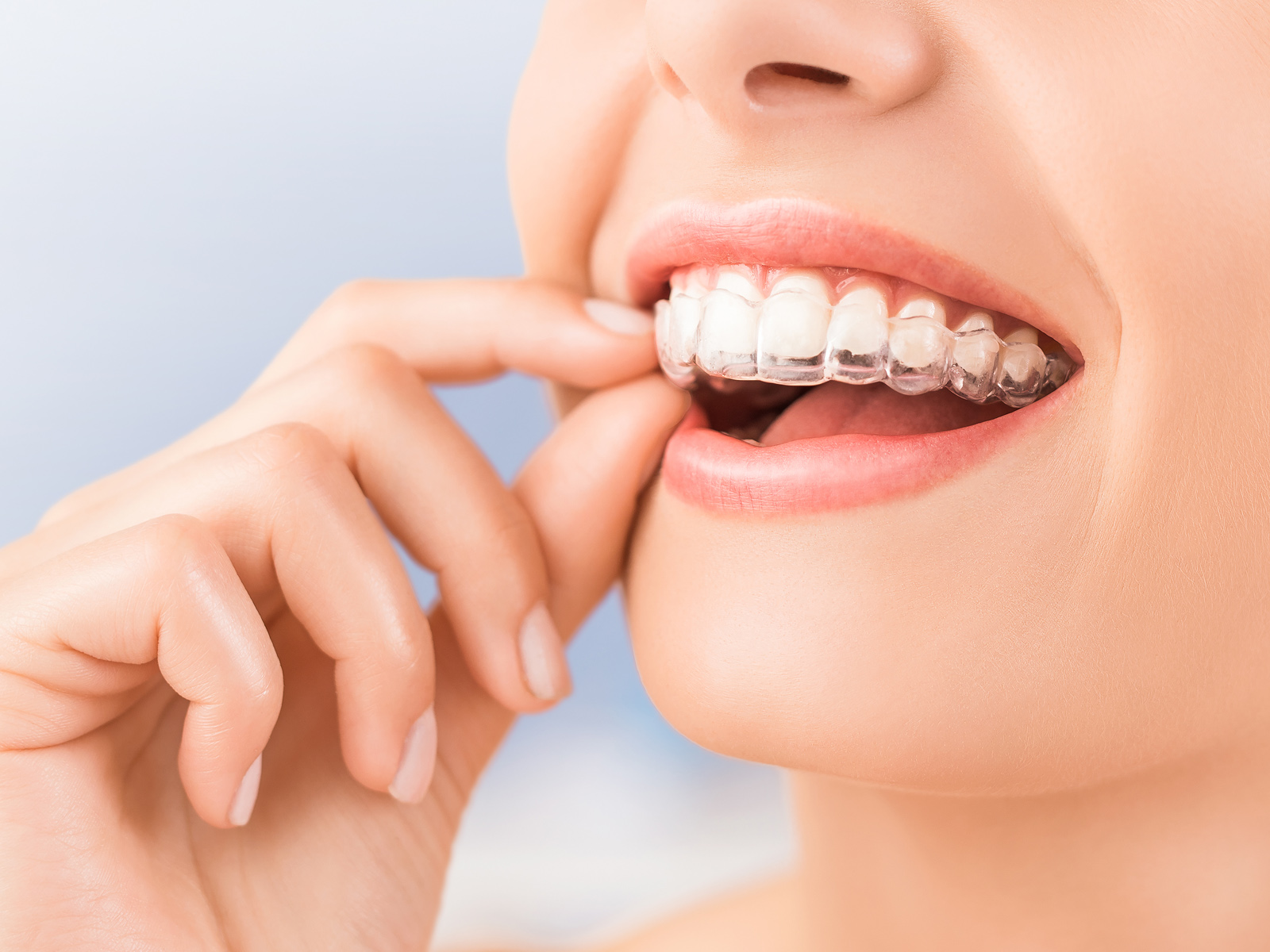 How long do Invisalign impressions take?