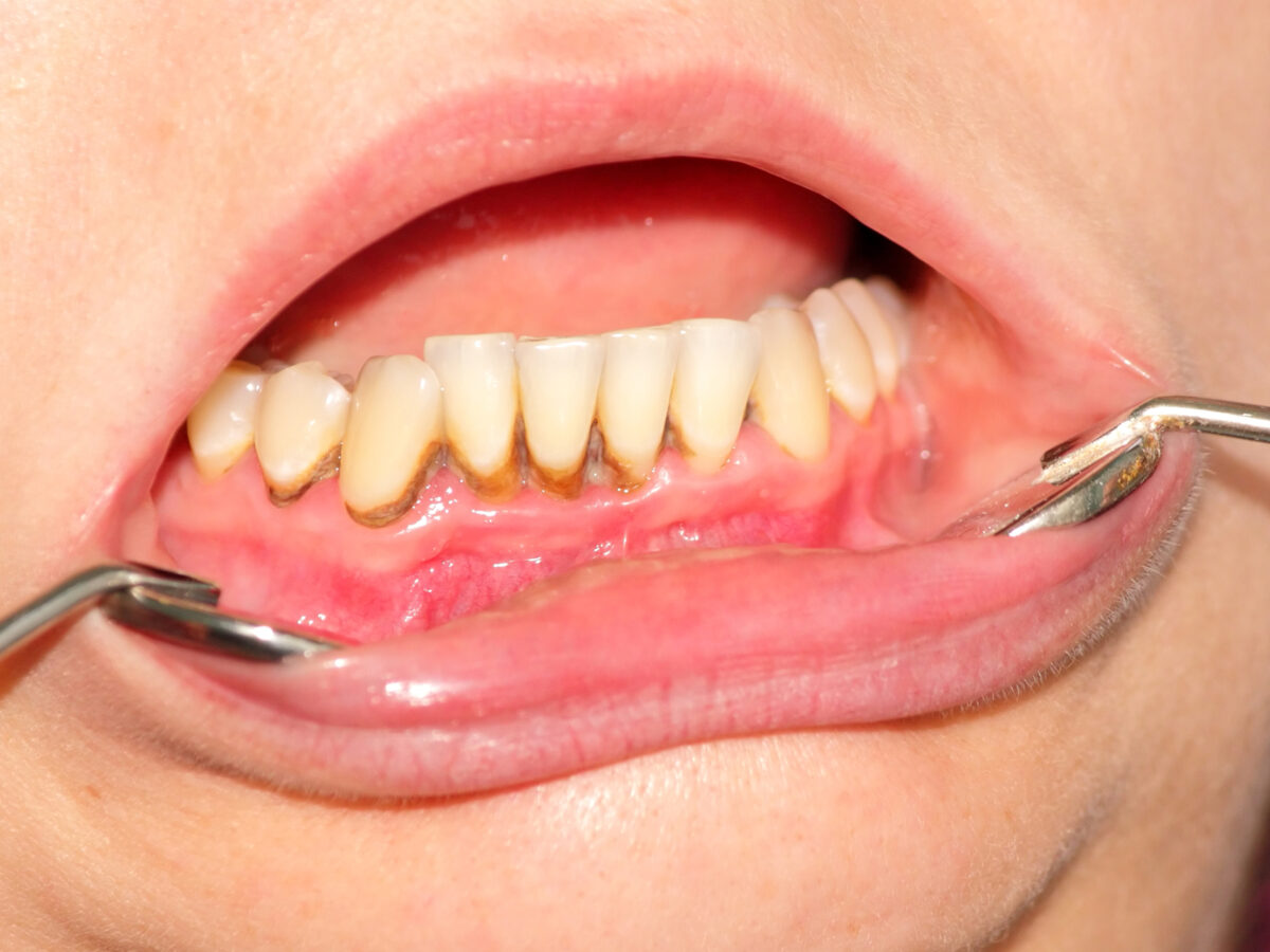 What are the five signs of poor oral hygiene?