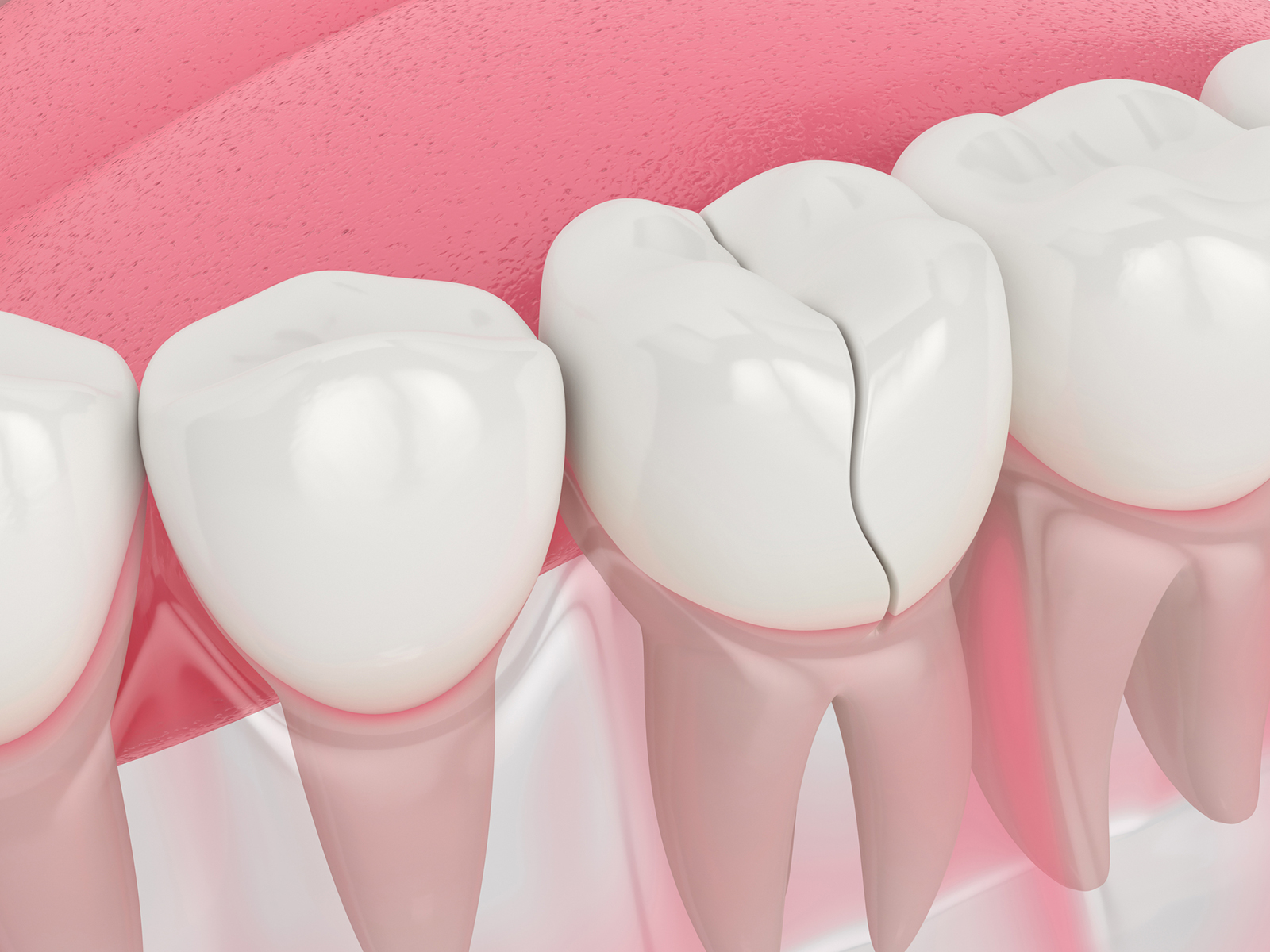 Endodontic Therapy To Save A Cracked Tooth