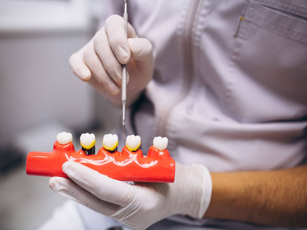 Dental implants