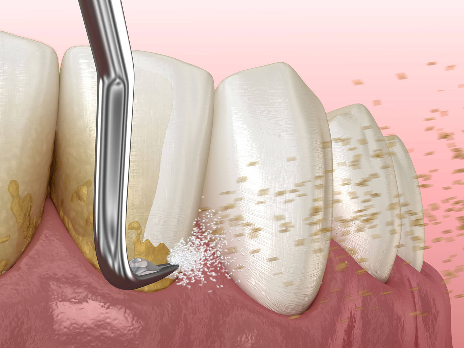 The Role of Scaling And Root Planing In Overall Health