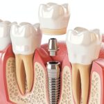 How To Maintain A Winning Smile After Dental Implant Surgery