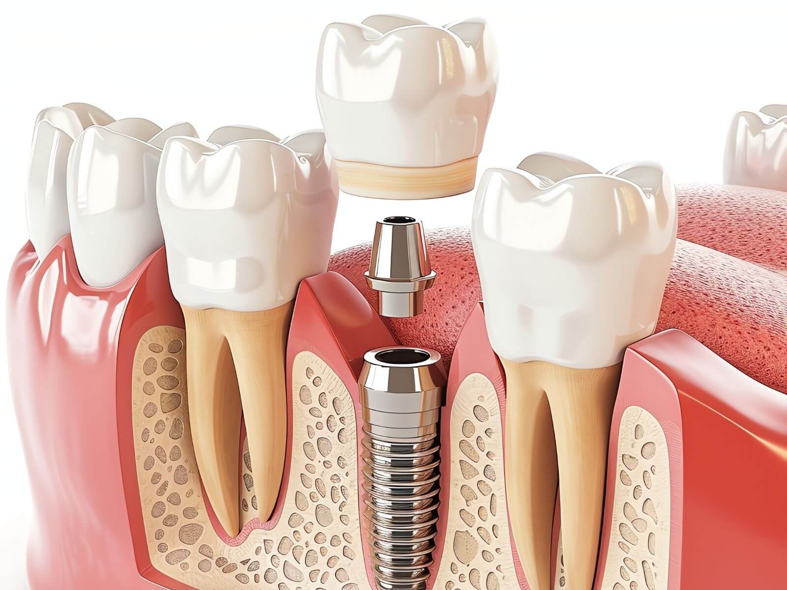 How To Maintain A Winning Smile After Dental Implant Surgery