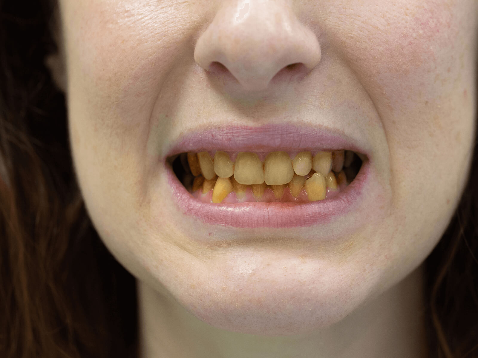 How to Remove Tobacco Stains from Teeth?