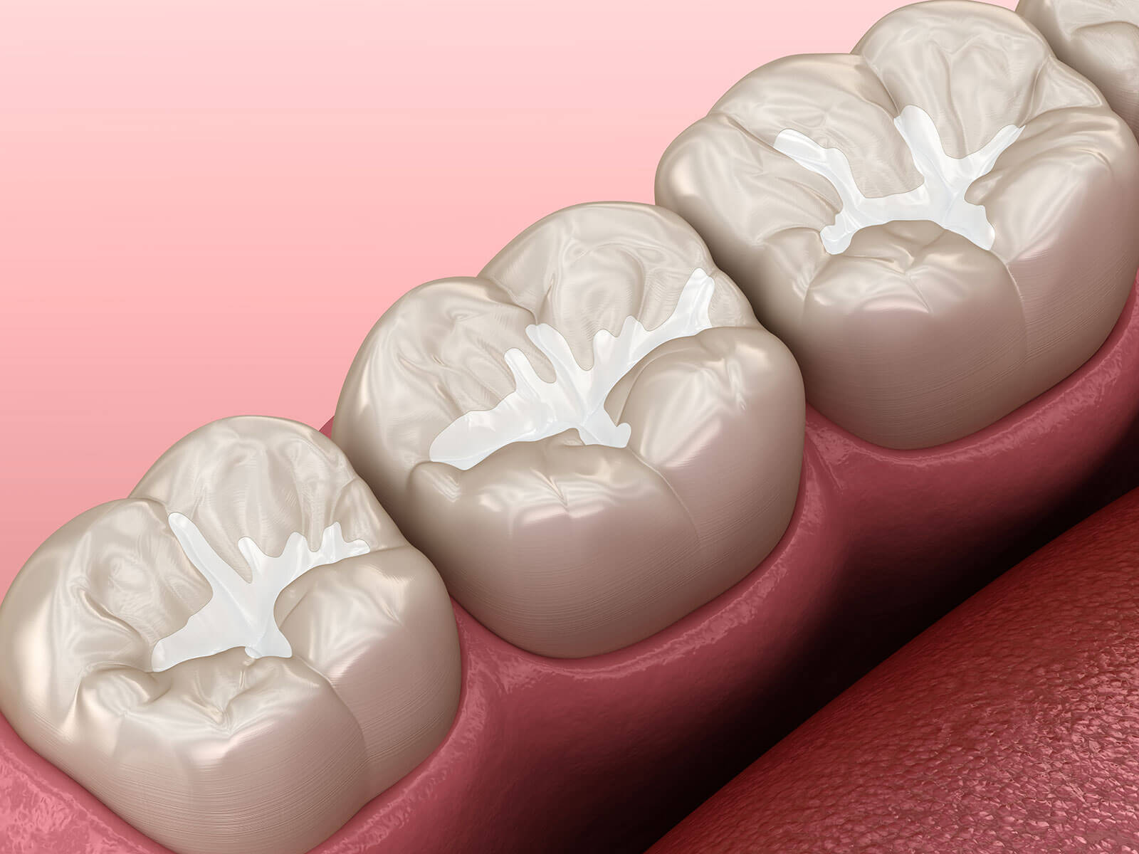 Dental Crowns vs Veneers: Differences, Benefits & Uses