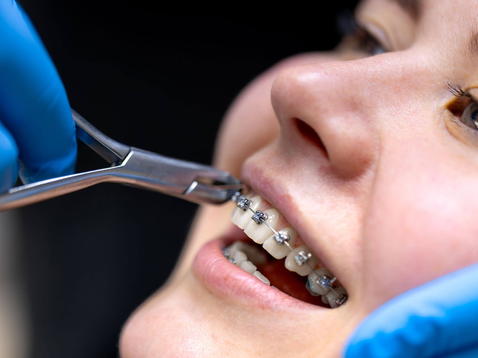 How Much Do Braces Cost? Complete Pricing Guide